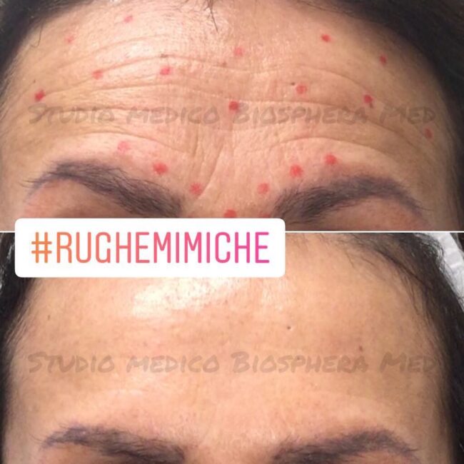 Botulino: distensione rughe – Biosphera Med