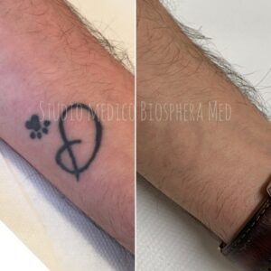 Epilazione tatuaggi brescia - prima e dopo (1)