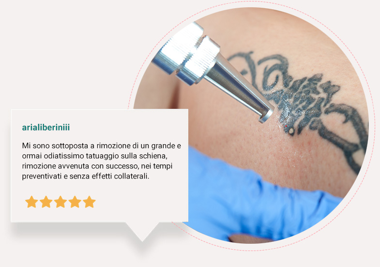 Epilazione tatuaggi brescia